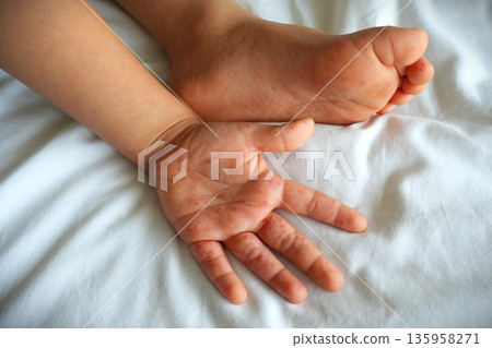 Hand foot and mouth disease (HFMD) rash and blisters on a child's hand and leg. 135958271