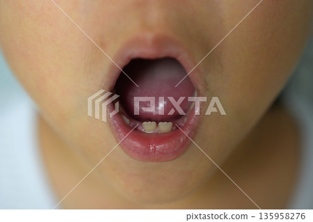 Child's Mouth Showing a Missing Baby Tooth and New Permanent Tooth Growing Child's Mouth Showing a Missing Baby Tooth and New Permanent Tooth Growing 135958276