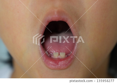 Child's Mouth Showing a Missing Baby Tooth and New Permanent Tooth Growing Child's Mouth Showing a Missing Baby Tooth and New Permanent Tooth Growing 135958277