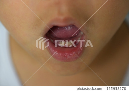 Child's Mouth Showing a Missing Baby Tooth and New Permanent Tooth Growing 135958278