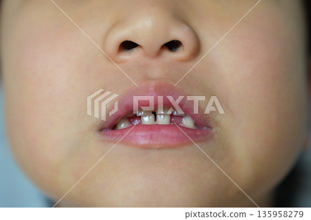 Child's Mouth Showing a Missing Baby Tooth and New Permanent Tooth Growing 135958279