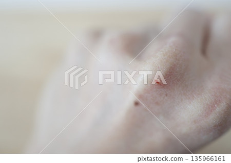 Close-up of the back of a hand with dry, cracked skin and slight bleeding. 135966161