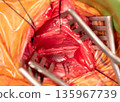 Vagus Nerve During vagal nerve stimulation (VNS) Implantation Surgery 135967739