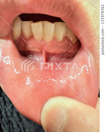 Mouth ulcers under the gums Mouth ulcers under the gums 135976562