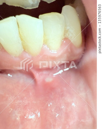 Mouth ulcers under the gums Mouth ulcers under the gums 135976563