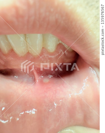 Mouth ulcers under the gums 135976567