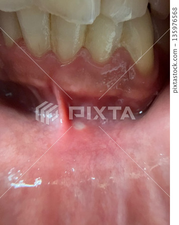 Mouth ulcers under the gums Mouth ulcers under the gums 135976568