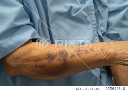 Ecchymosis, elderly bleeding on her arm after taking aspirin. Ecchymosis, elderly bleeding on her arm after taking aspirin. 135992848
