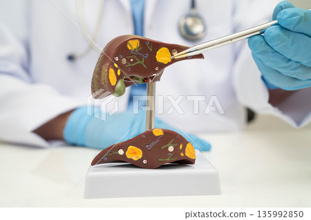 Cirrhosis, Liver cancer, fatty liver, Asian doctor with liver human anatomy model in World Hepatitis Day at hospital. 135992850