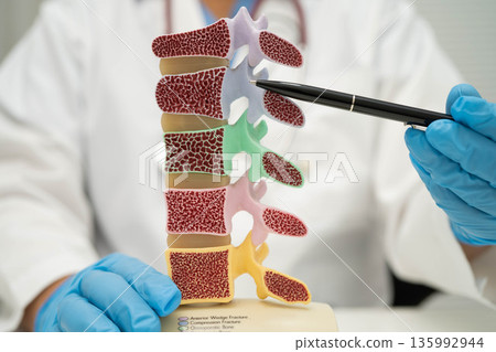Doctor holding osteoporosis in back bone model for treatment medical in orthopedic department. Doctor holding osteoporosis in back bone model for treatment medical in orthopedic department. 135992944