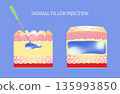 Injectable cosmetic filler or dermal fillers. Before and after. Lifting concept 135993850