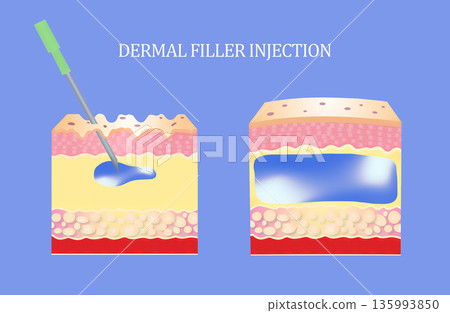 Injectable cosmetic filler or dermal fillers. Before and after. Lifting concept 135993850