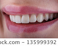 Female smile makeover by dental ceramic veneers, porcelain laminate veneers. Side view 135999392