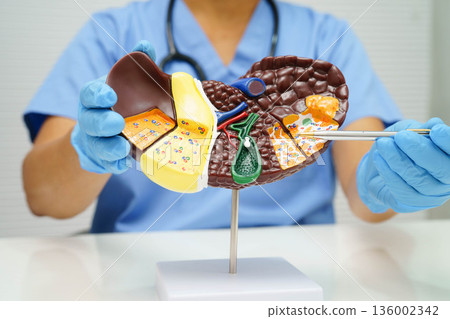 Cirrhosis, Liver cancer, fatty liver, Asian doctor with liver human anatomy model in World Hepatitis Day at hospital. Cirrhosis, Liver cancer, fatty liver, Asian doctor with liver human anatomy model in World Hepatitis Day at hospital. 136002342