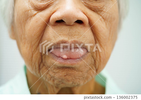 Cysts at the tongue in mouth of Asian elderly old lady woman patient. Cysts at the tongue in mouth of Asian elderly old lady woman patient. 136002375