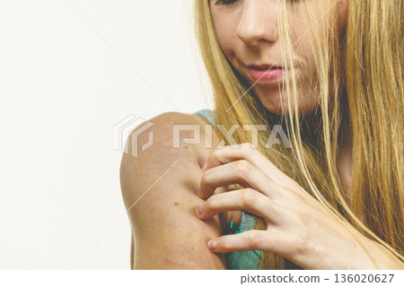 Woman scratching her itchy arm. Skin allergy. Woman scratching her itchy arm. Skin allergy. 136020627