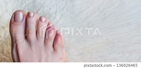 Close up of a bare foot with a broken or sprained bruised reddened toes phalanges. Copy space Close up of a bare foot with a broken or sprained bruised reddened toes phalanges. Copy space 136026465