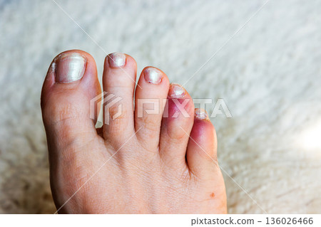 Close up of a bare foot with a broken or sprained bruised reddened fourth and fifth toes distal and middle phalanges Close up of a bare foot with a broken or sprained bruised reddened fourth and fifth toes distal and middle phalanges 136026466