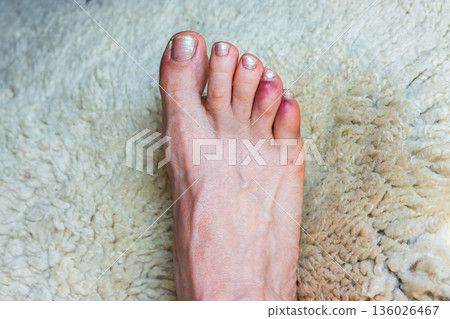 Close up of a bare foot with a broken or sprained bruised reddened fourth and fifth toes distal and middle phalange Close up of a bare foot with a broken or sprained bruised reddened fourth and fifth toes distal and middle phalange 136026467