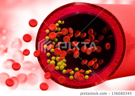 Cholesterol plaque in blood vessel 136080345