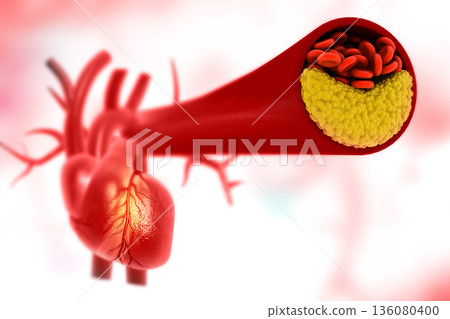 Clogged Arterie Clogged Arterie 136080400