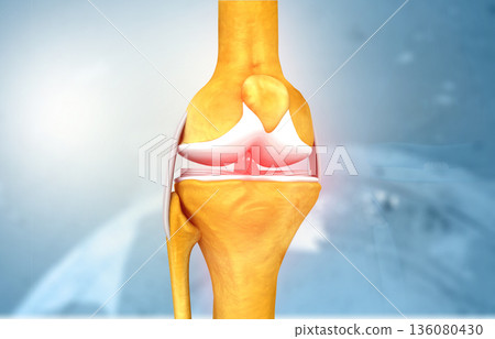 knee joint arthritis knee joint arthritis 136080430