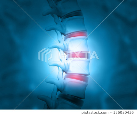 Disc problem of human spine Disc problem of human spine 136080436