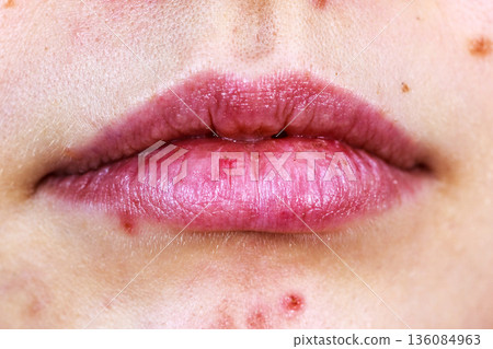 Female face with acne skin problem Female face with acne skin problem 136084963