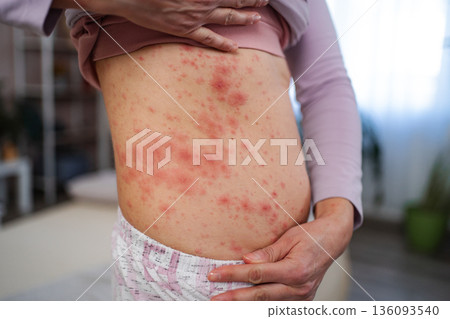 Person suffering from painful rash on body skin 136093540