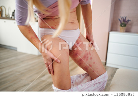 Woman experiencing skin rash and irritation feeling discomfort Woman experiencing skin rash and irritation feeling discomfort 136093955