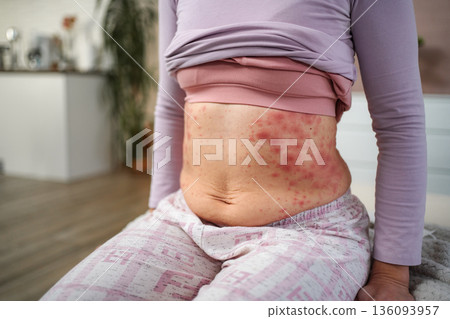 Woman experiencing severe allergic skin rash on abdomen Woman experiencing severe allergic skin rash on abdomen 136093957