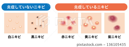Illustration of types of acne | With and without inflammation Illustration of types of acne | With and without inflammation 136105435