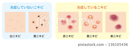 Illustration of types of acne | With and without inflammation 136105436