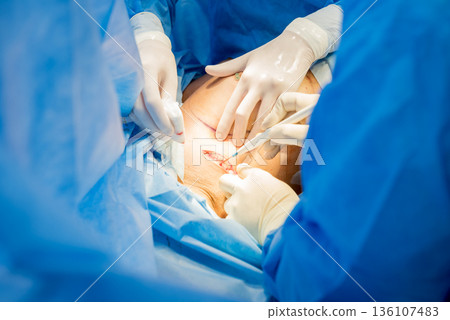 Surgery to remove the breast and replace it with an implant. Surgery to remove the breast and replace it with an implant. 136107483