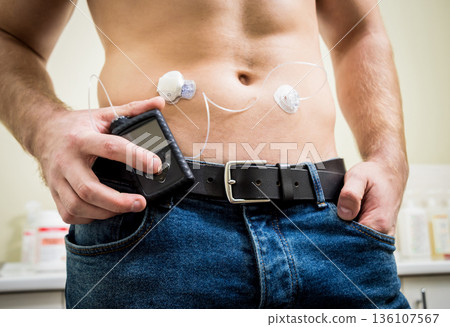 Diabetic man with an insulin pump connected in his abdomen Diabetic man with an insulin pump connected in his abdomen 136107567