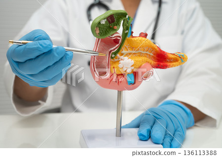 Pancreatitis, pancreatic cancer, Asian doctor with pancreas, gallbladder and bile duct human model. 136113388