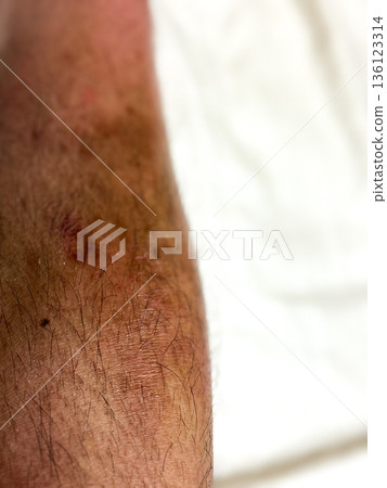 Dermatitis on a man's shin Dermatitis on a man's shin 136123314