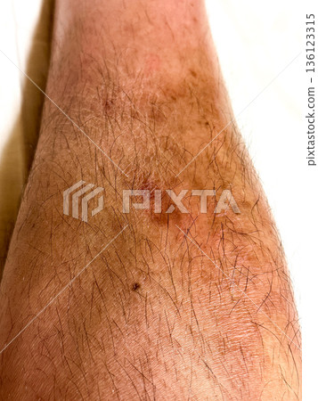 Dermatitis on a man's shin Dermatitis on a man's shin 136123315