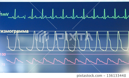Medical monitor displaying patient vital signs, heartbeat, pulse, and EKG data 136133448
