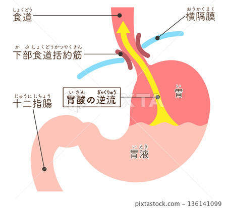 Acid reflux illustration Acid reflux illustration 136141099