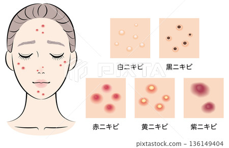 一位患有痤瘡的年輕女子，痤瘡類型多種多樣。 136149404