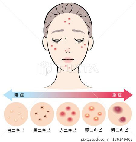 一系列痤瘡類型以及一位患有痤瘡的女性的臉部照片 136149405