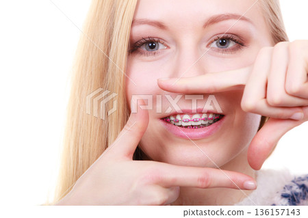 Happy woman showing her braces on teeth 136157143