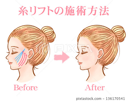 一名成年女性接受線雕整形手術的素材 一名成年女性接受線雕整形手術的素材 136170541