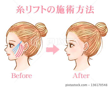 一名成年女性接受線雕提升整形手術的素材 2 136170548