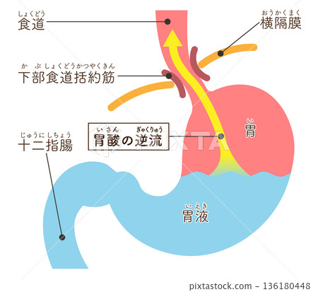 胃酸逆流示意圖 胃酸逆流示意圖 136180448