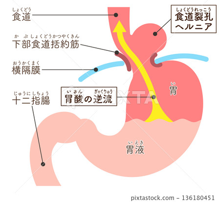 食道裂孔疝氣示意圖 136180451