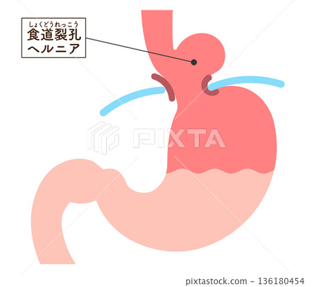食道裂孔疝氣示意圖 食道裂孔疝氣示意圖 136180454