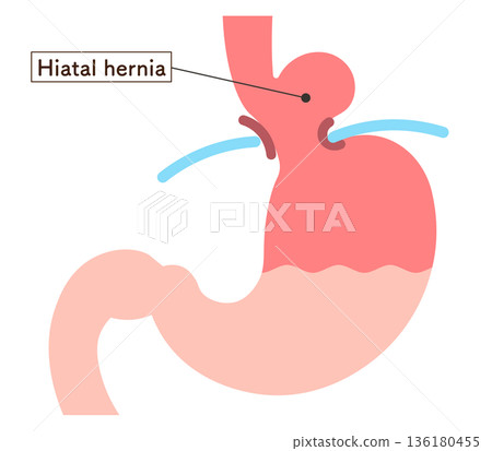 Hiatal hernia illustration Hiatal hernia illustration 136180455