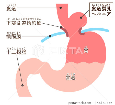 Hiatal hernia illustration Hiatal hernia illustration 136180456
